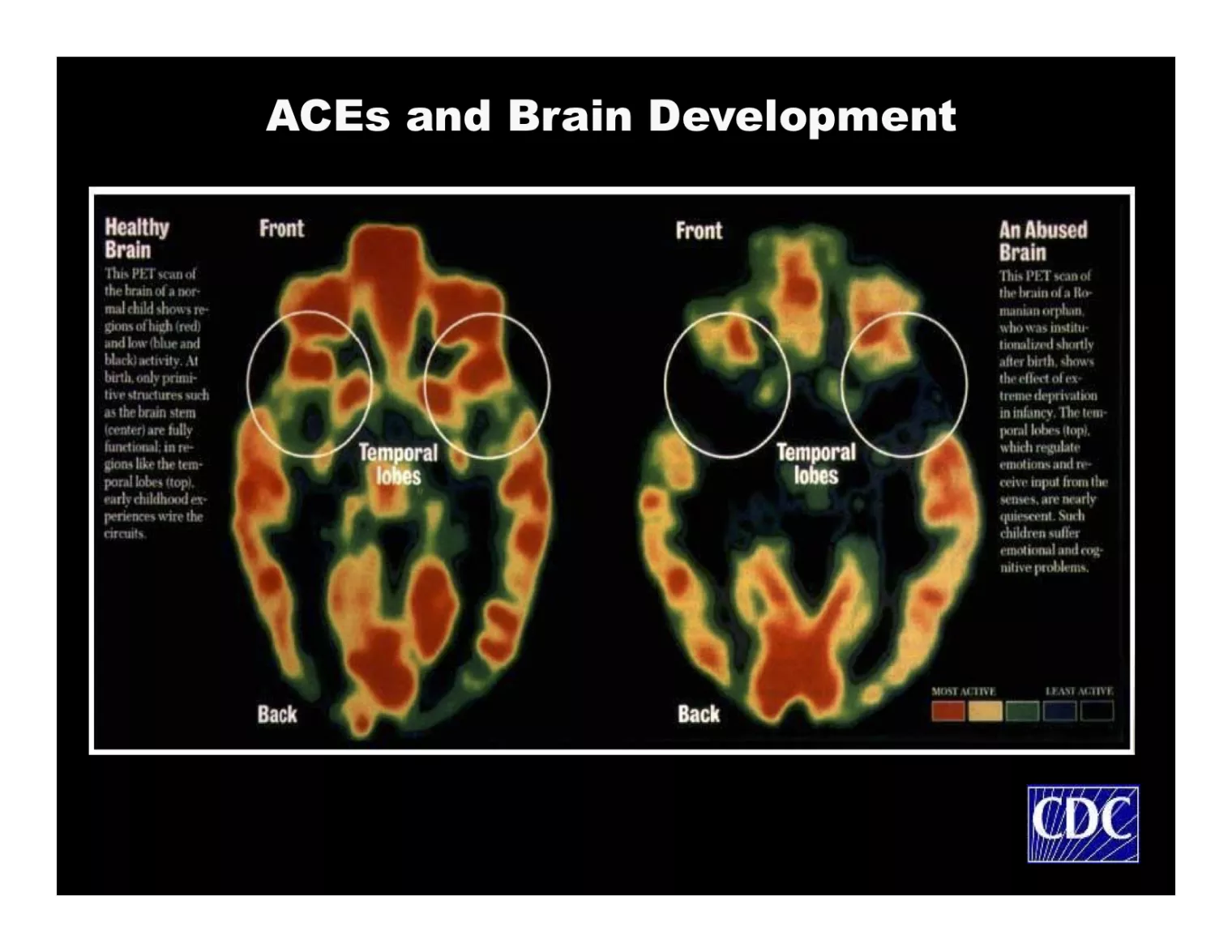 ACEs and Brain Development - MRI Image